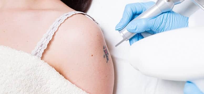 Woman getting Laser Tattoo Removal at Rendon Center