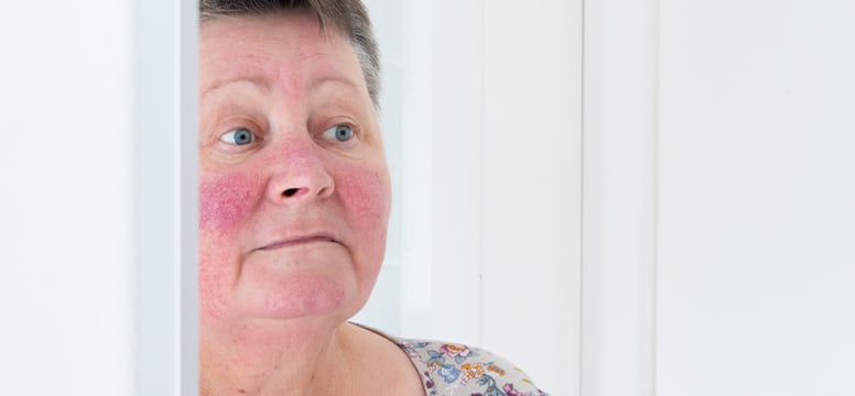 woman with signs of rosacea on her face