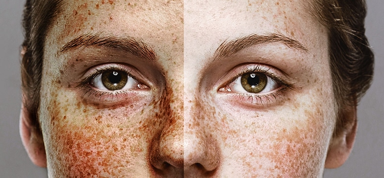 before and after comparison of sun damage