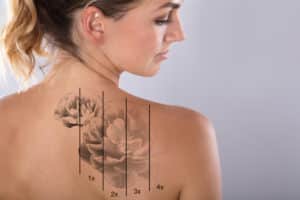 Woman with fading tattoo due to laser tattoo removal