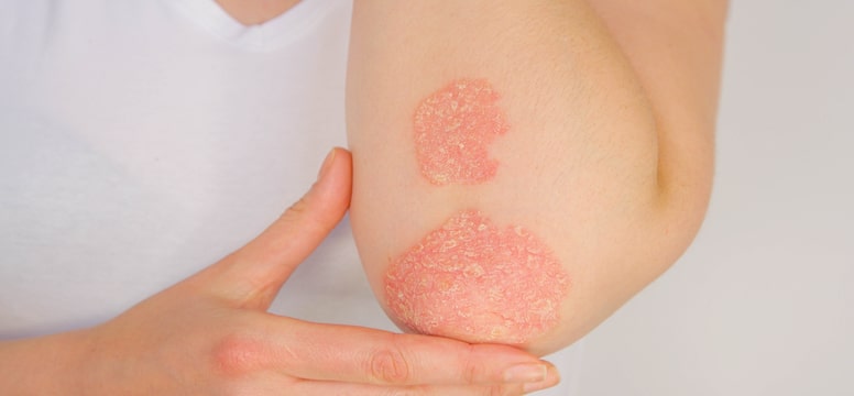 red, flaky patches of psoriasis on elbow and forearm