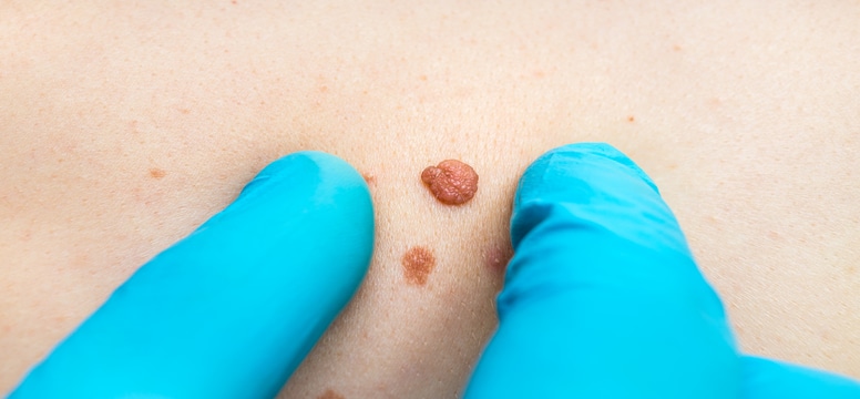 doctor examining skin tag