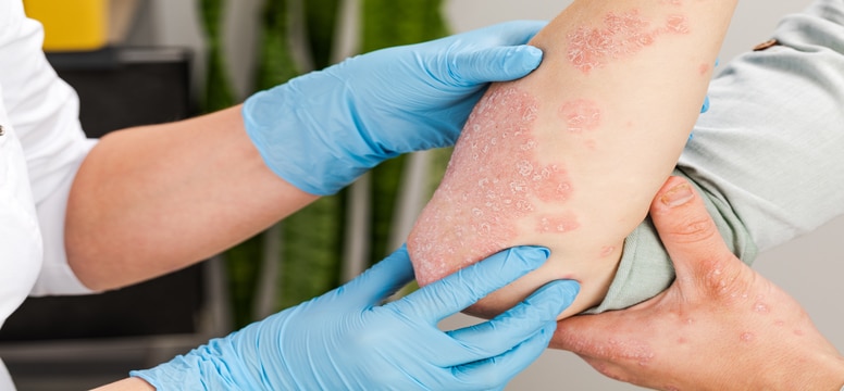 Dermatologist Inspecting Psoriasis Case On Patient