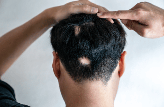 Asian guy point his hair loss