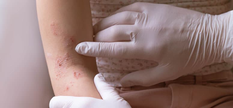 Eczema on a patient's arm being pointed out by a dermatologist