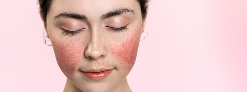 woman with her eyes closed, showing inflamed blood vessels on her cheeks.