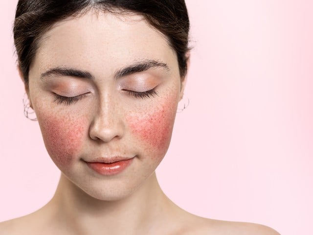 woman with her eyes closed showing inflamed blood vessels on her cheeks.