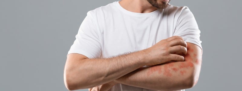 Annoyed middle-aged man in white t-shirt scratching itch on his arm