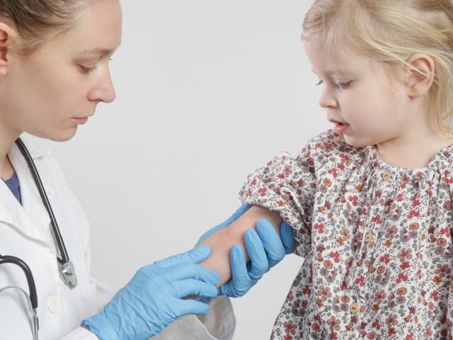 Doctor looking at red and itchy eczema on little girls arm