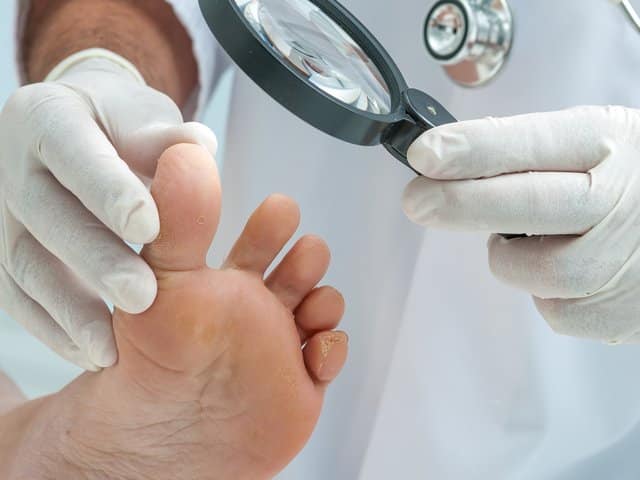 Doctor dermatologist examines the foot on the presence of athlete's foot