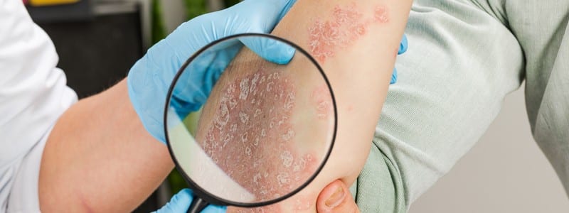 dermatologist examines and diagnose the skin diseases psoriasis eczema dermatitis.