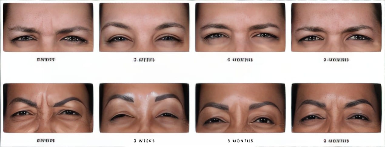 many patients' foreheads before and after daxxify with less lines between brows after treatment