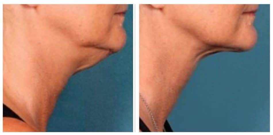 Ozempic Face sagging skin treatment