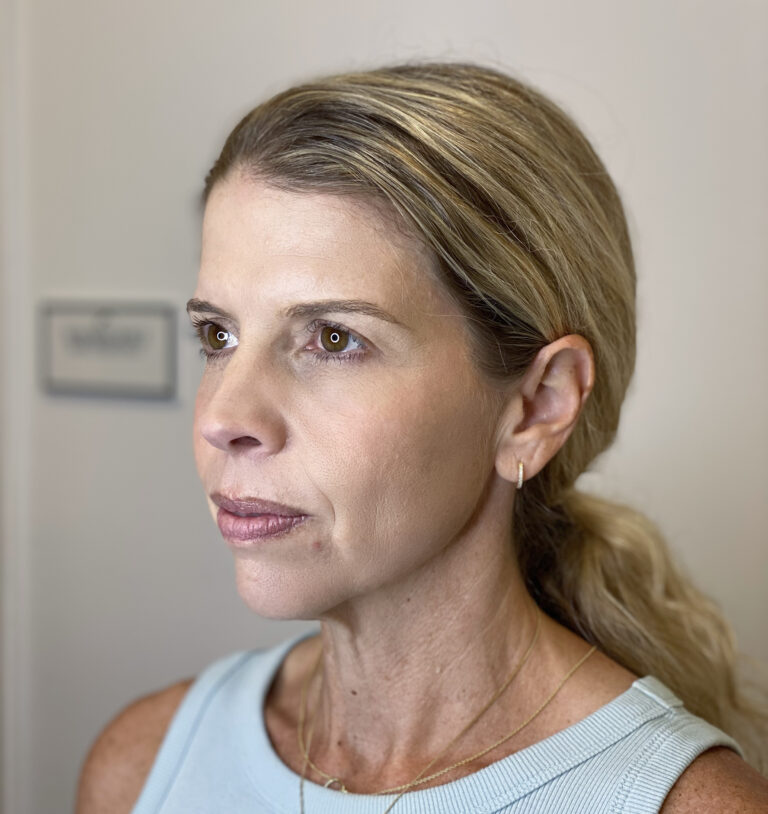 After Image: Chemical Peel - left-front-oblique