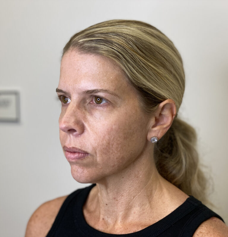 Before Image: Chemical Peel - left-front-oblique