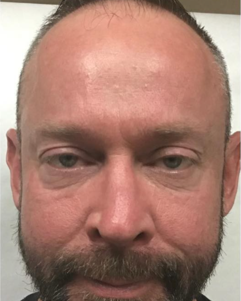 After Image: Botox – Men’s Forehead - front