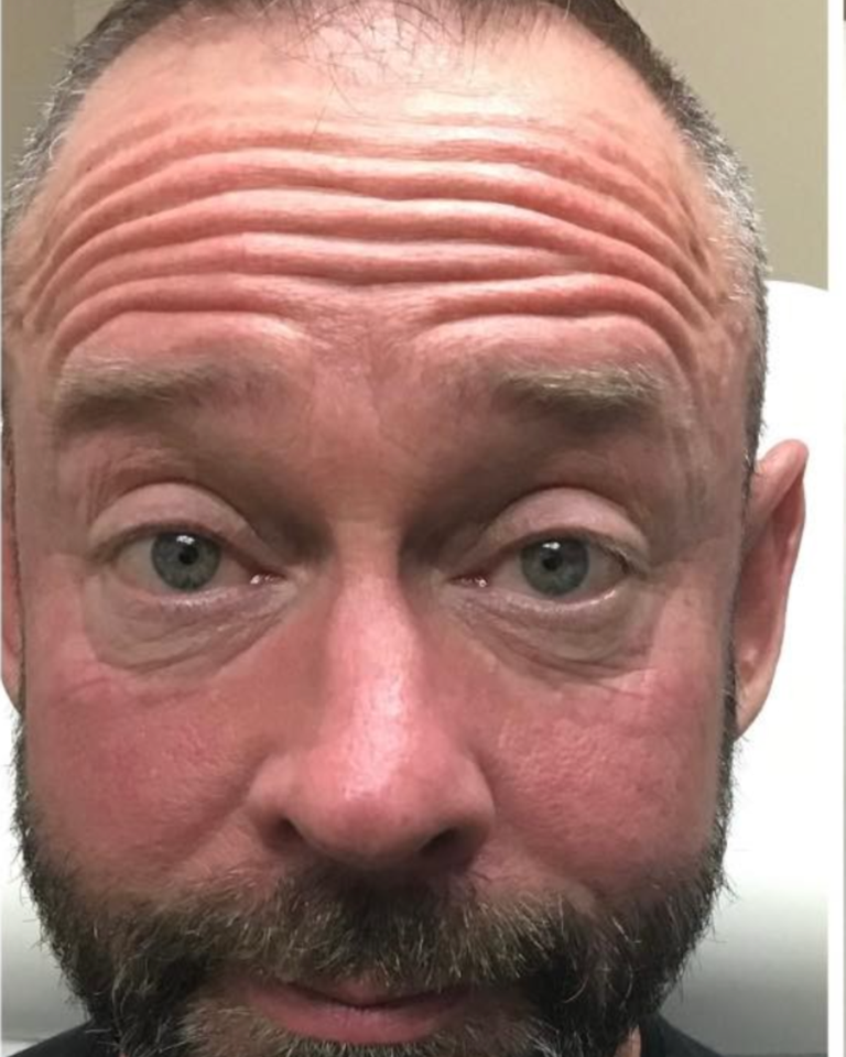 Before Image: Botox – Men’s Forehead - front