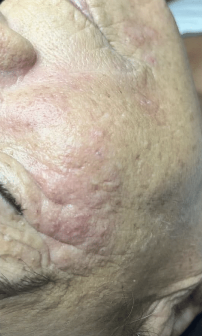 After Image: Extractions - right-side