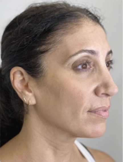 After Image: Microneedling - right-front-oblique