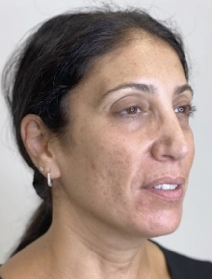 Before Image: Microneedling - right-front-oblique