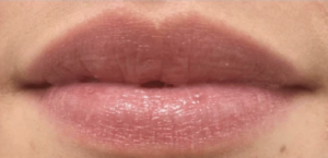 After Image: Restylane Kysse