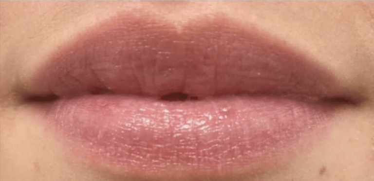 After Image: Restylane Kysse - front