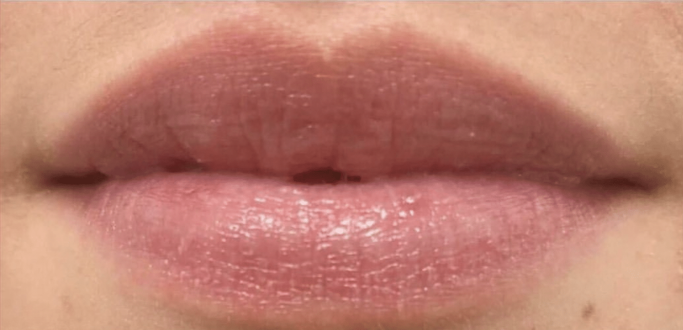 After Image: Restylane Kysse - front