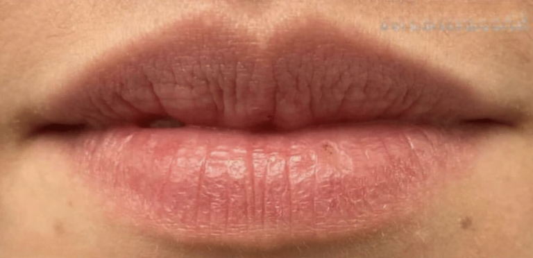 Before Image: Restylane Kysse - front
