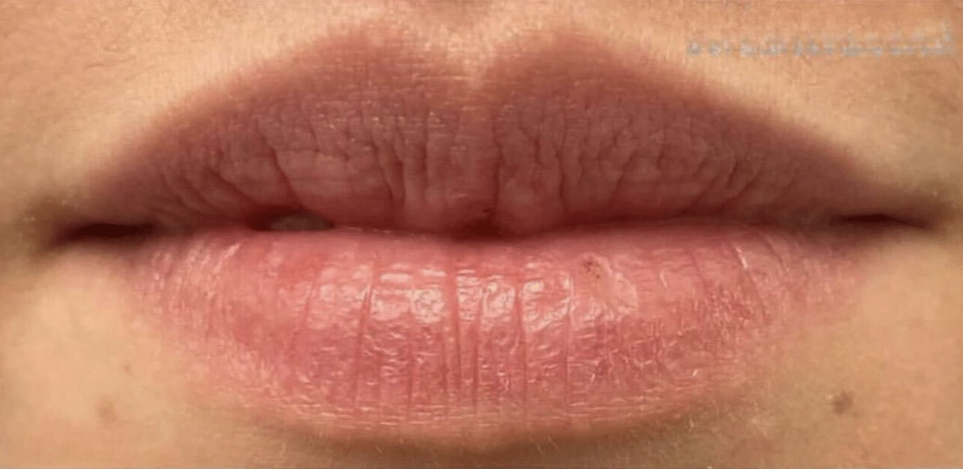Before Image: Restylane Kysse - front