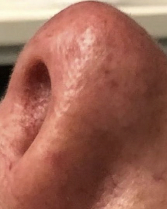After Image: Sclerotherapy - left-side