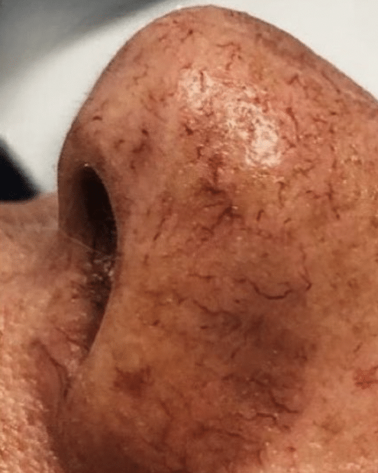 Before Image: Sclerotherapy - left-side