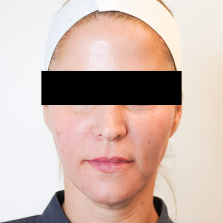 After Image: Sculptra - front