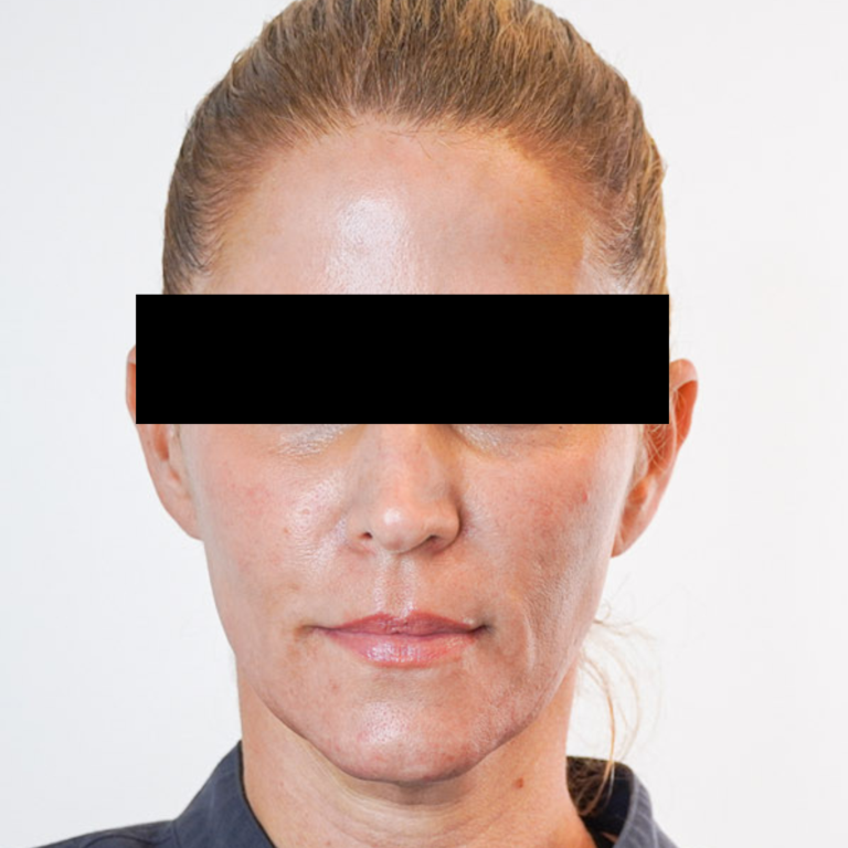 Before Image: Sculptra - front